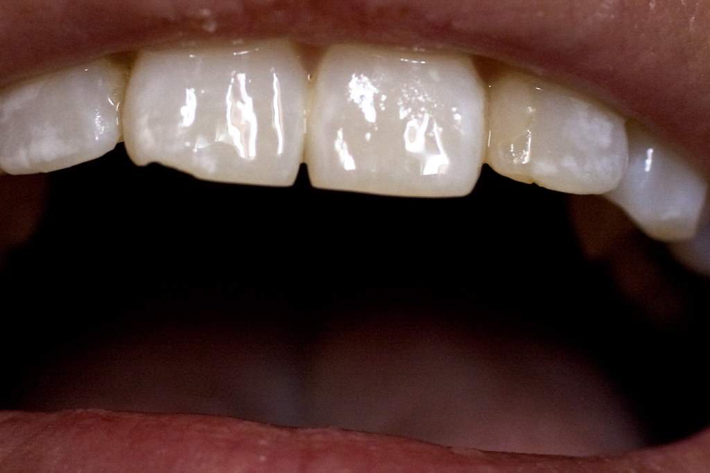 What To Do About A Chipped Tooth