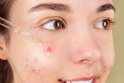 5 Things to Try When Acne Won’t Clear