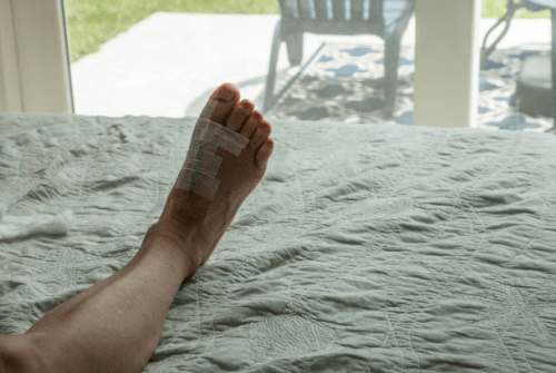 Considerations for Minimally Invasive Bunion Surgery in Singapore