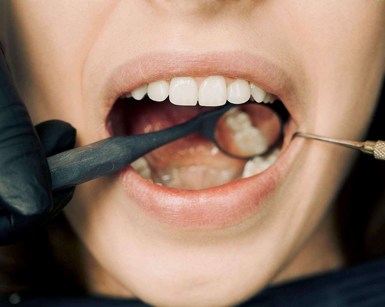 Are Dental Crowns Right for You? 7 Signs You Might Need One