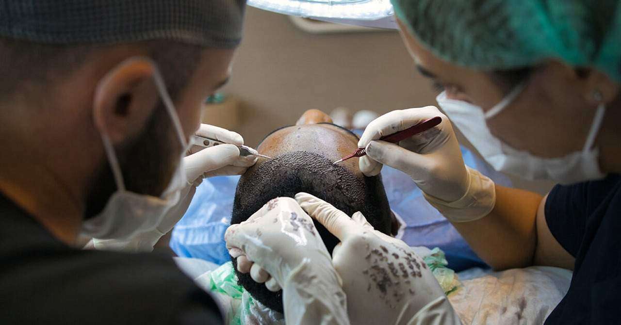 Hair Transplants for Alopecia: A Lifeline for Sufferers